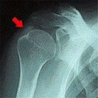 石灰沈着性腱炎